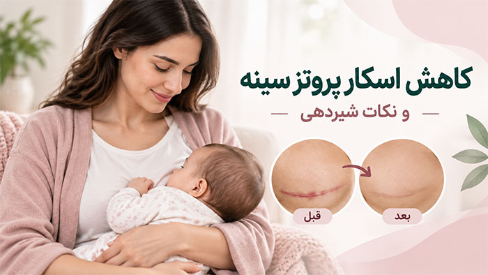 بیماری کاهش اسکارهای بعد عمل پروتز سینه و نکات شیردهی